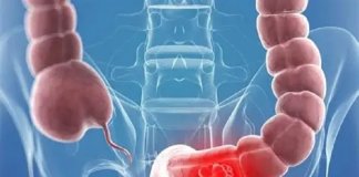 Una senzilla prova per aturar el càncer més comú, el de còlon i recte